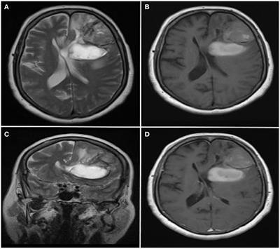 Case report: Spinal drop metastasis of IDH-mutant, 1p/19q-codeleted oligodendroglioma